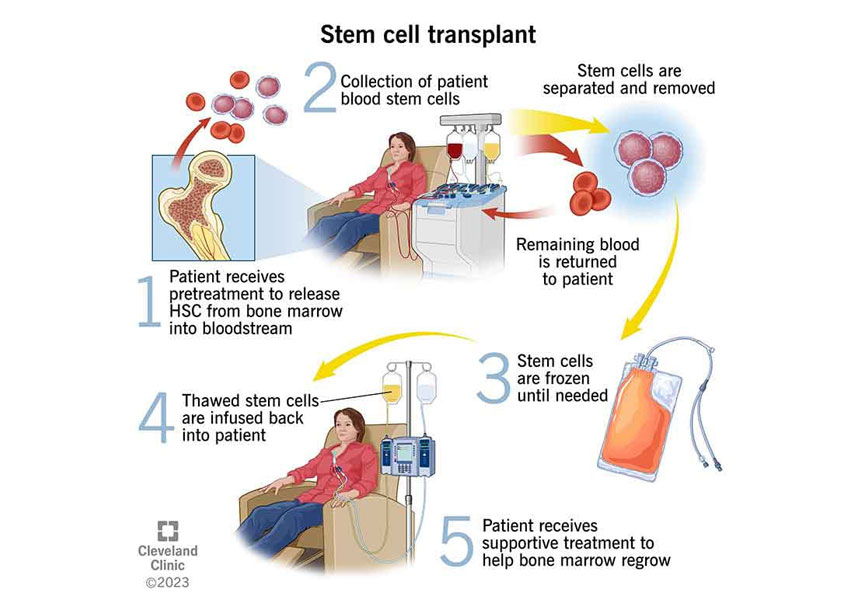 Hematopoietic Stem Cell Transplantation